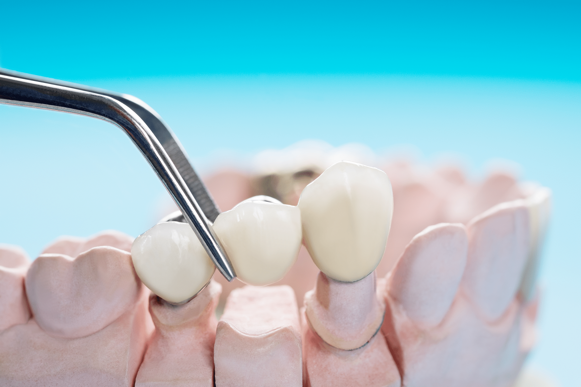 Dental Bridges VS Dental Implants - What's The Difference? Dr. Rossow DDS, Laura Noce DMD, Joseph Burns DDS, Cheri Neal DDS. Aspen Dental General, Cosmetic, Restorative, Preventative, Family Dentistry dentist in Denver CO 80206 aspen dental dentist in cherry creek denver co