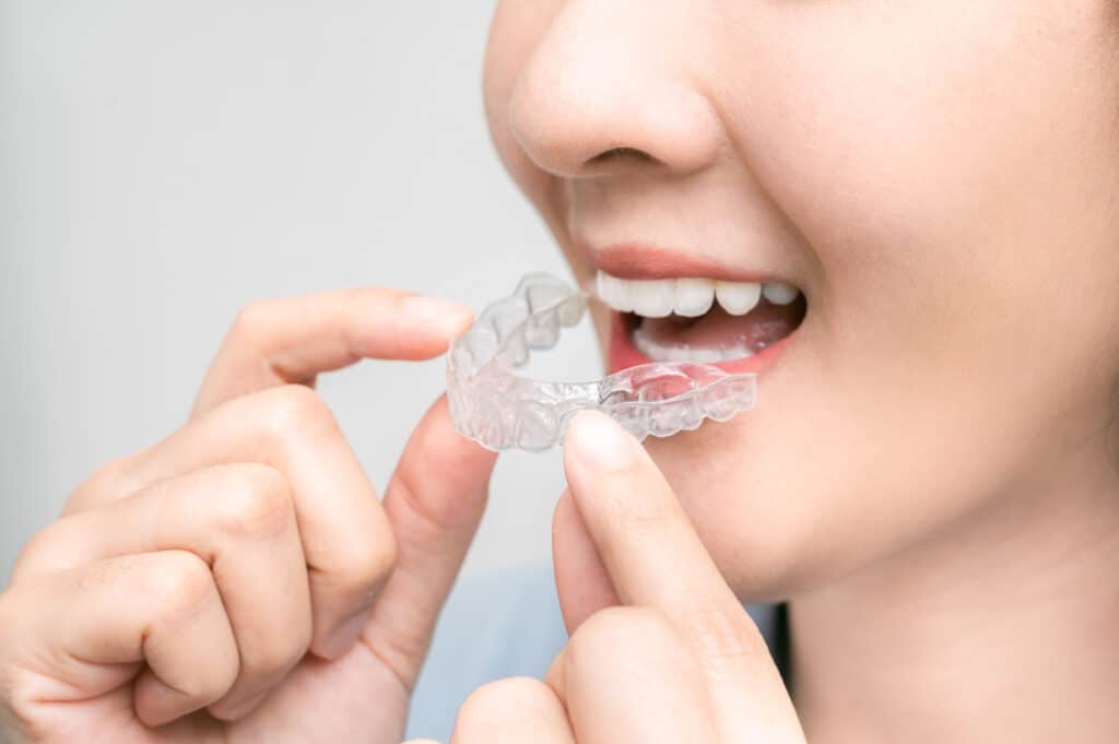 Clear Aligners Denver