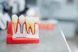 Dental Implants Denver